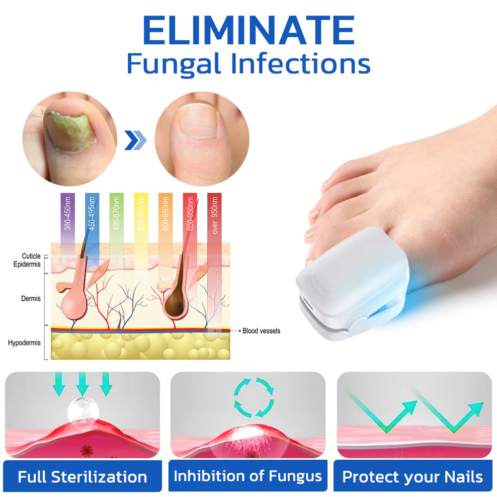 GFOUK™ FungusOFF Nail Laser Treatment Device