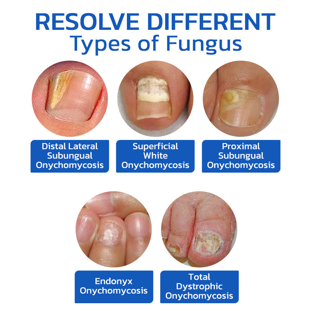 GFOUK™ FungusOFF Nail Laser Treatment Device