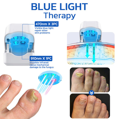 GFOUK™ FungusOFF Nail Laser Treatment Device