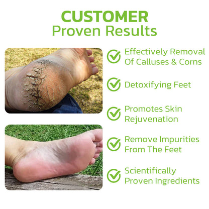 GFOUK™ IHerbal Foot Callus And Corns Removal Soak