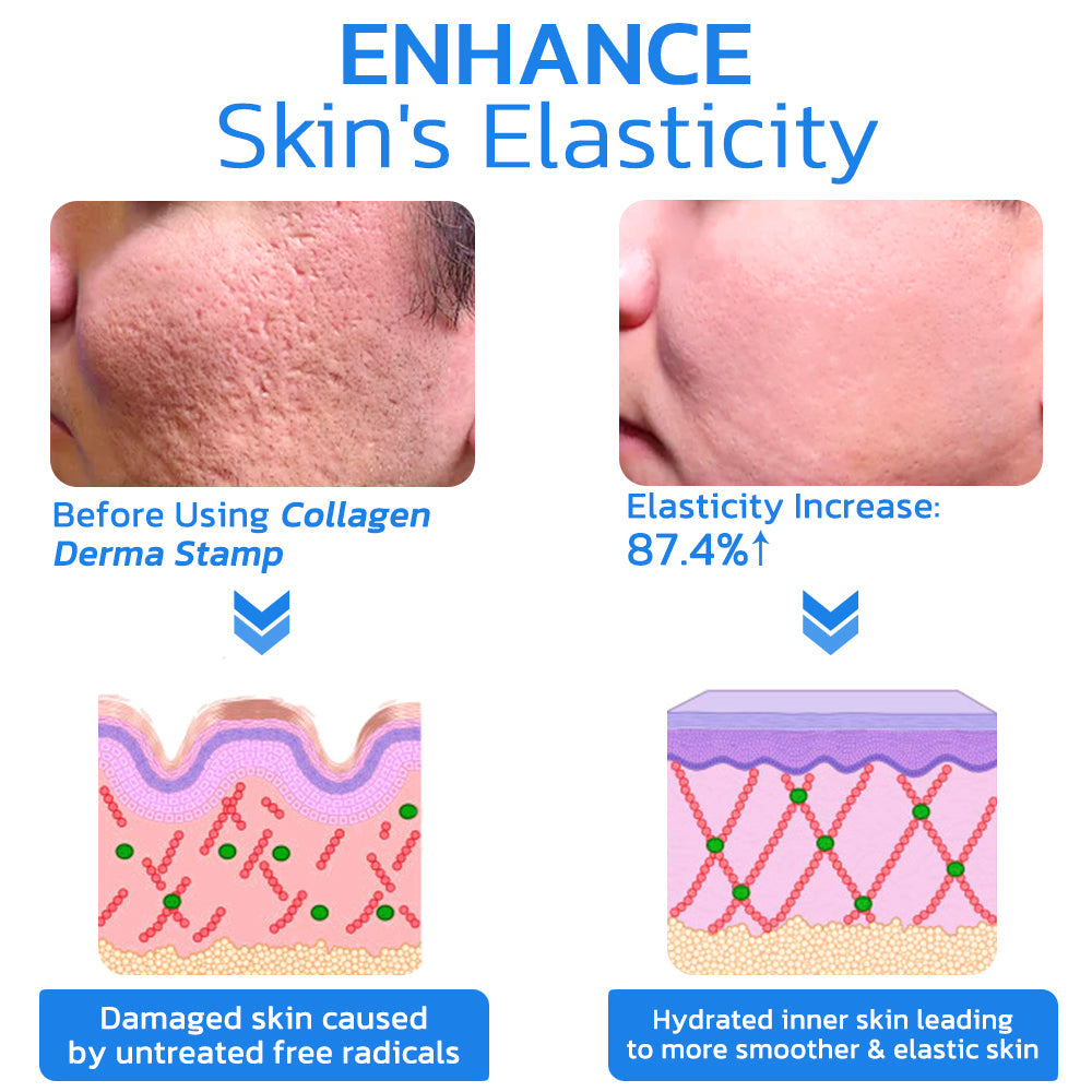 flysmus™ PockmarksNeedling Collagen Derma Stamp