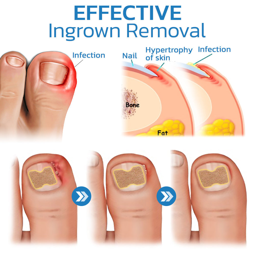 ToeHeal Paronychia Relief Patch