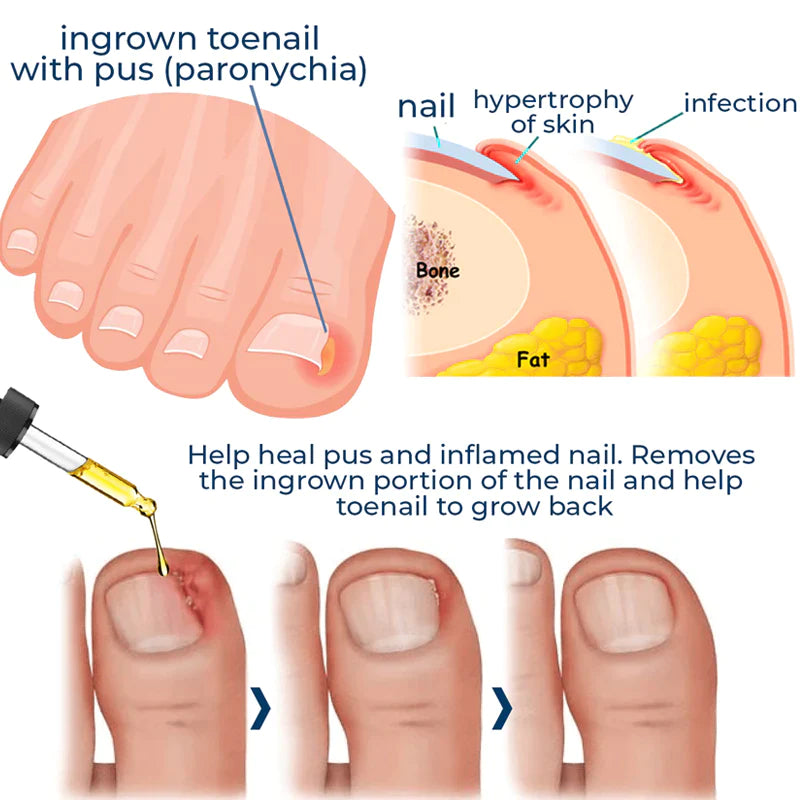 German Toenail Plus™ Anti-Paronychia Relief Oil