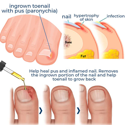 German Toenail Plus™ Anti-Paronychia Relief Oil