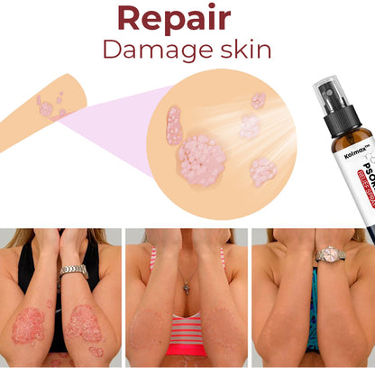 Kolmax™ Psoriasis Relief Spray